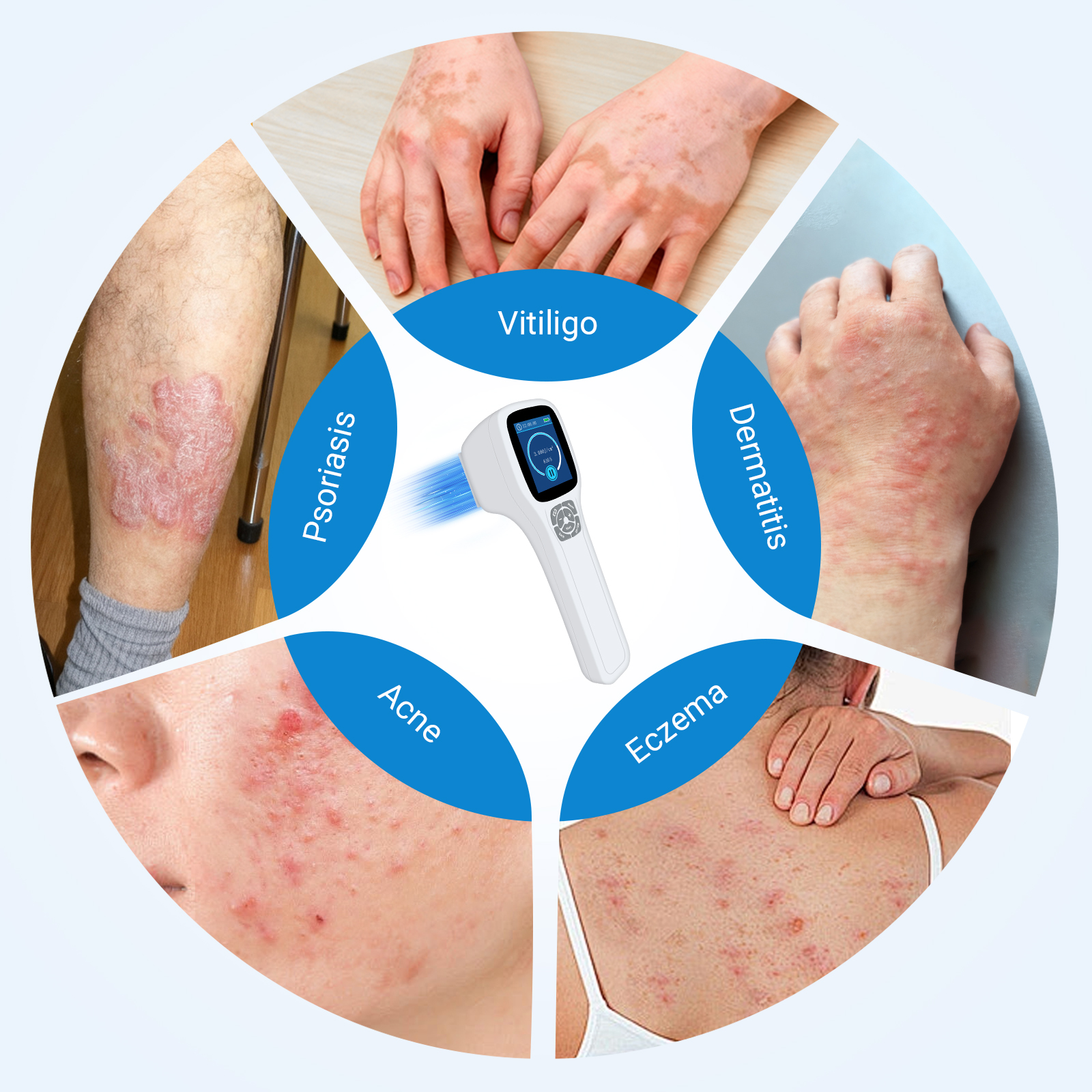 ZJKZ-excimer 308 nm laser