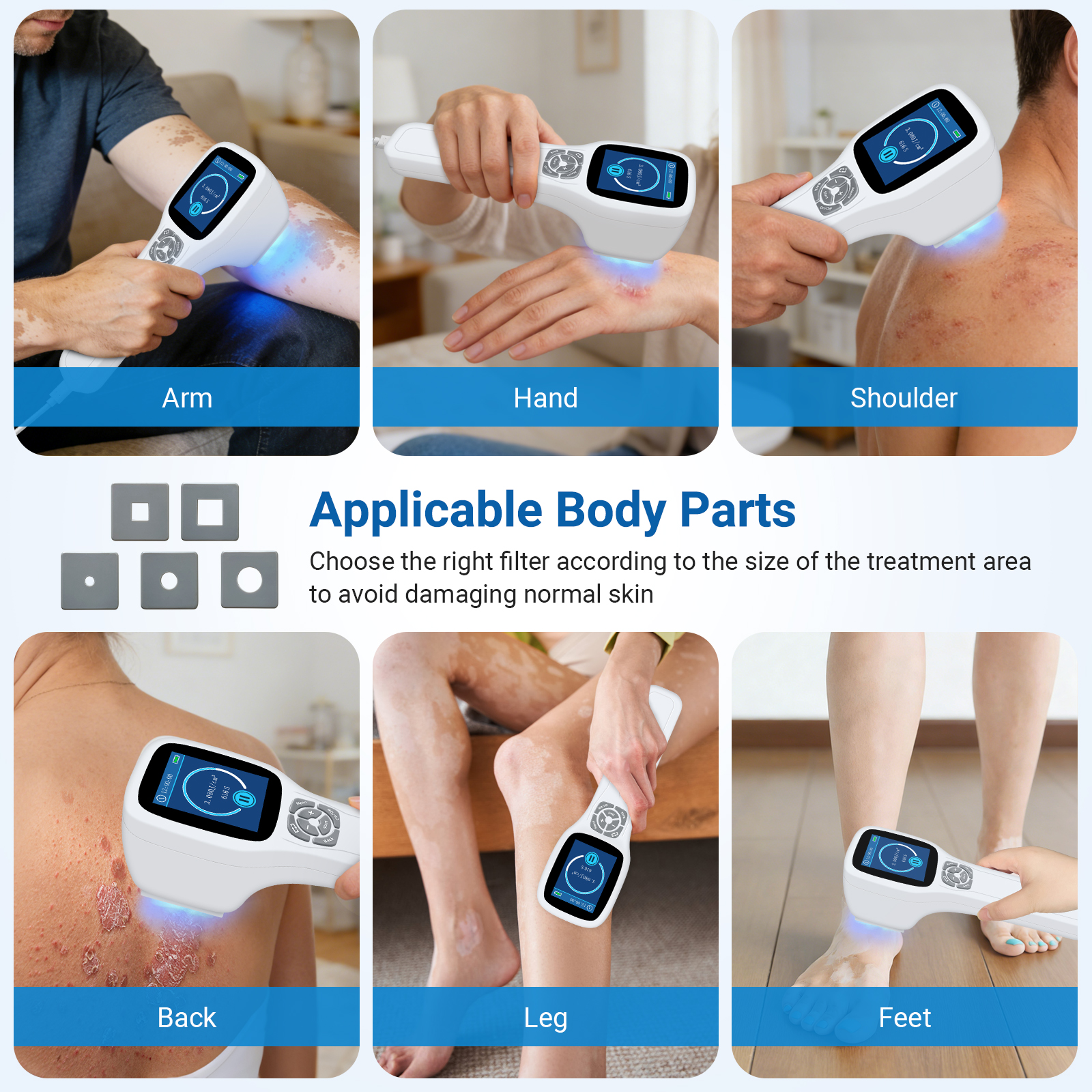 ZJKZ-excimer laser for psoriasis