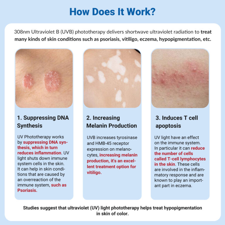 ZJKZ-excimer laser vitiligo