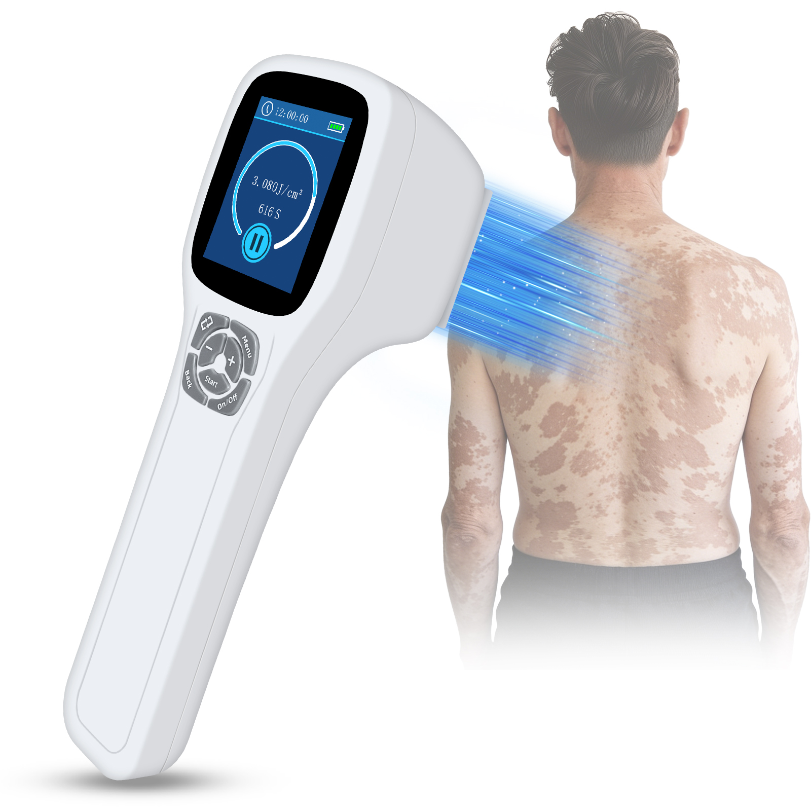 ZJKZ-excimer laser vitiligo machine