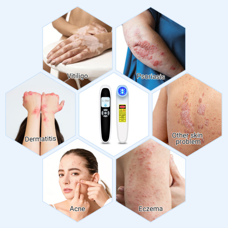 ZJKZ-laser excimer 308 nm