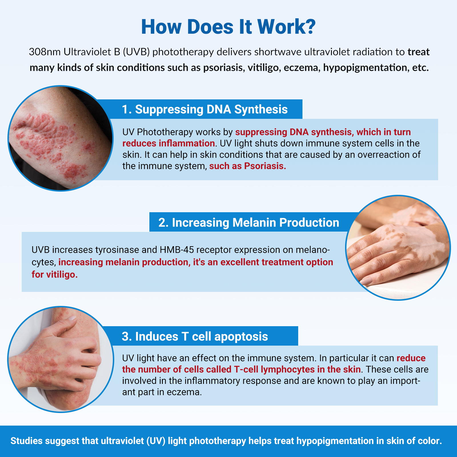 ZJKZ-laser excimer para vitiligo