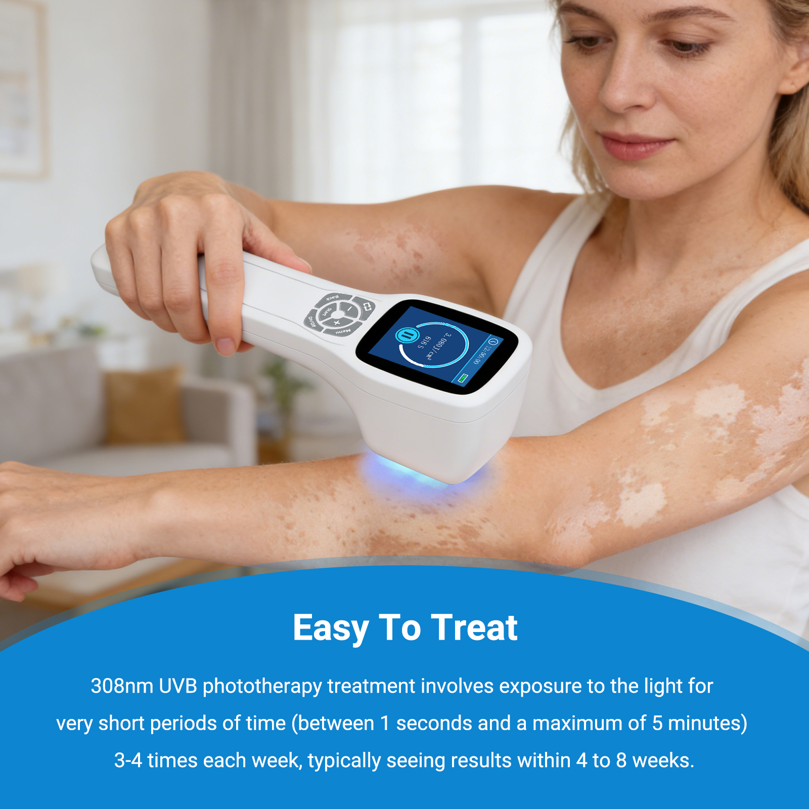 ZJKZ-uv light for psoriasis