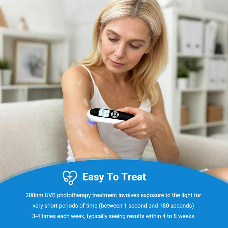 ZJKZ-vitiligo excimer treatment